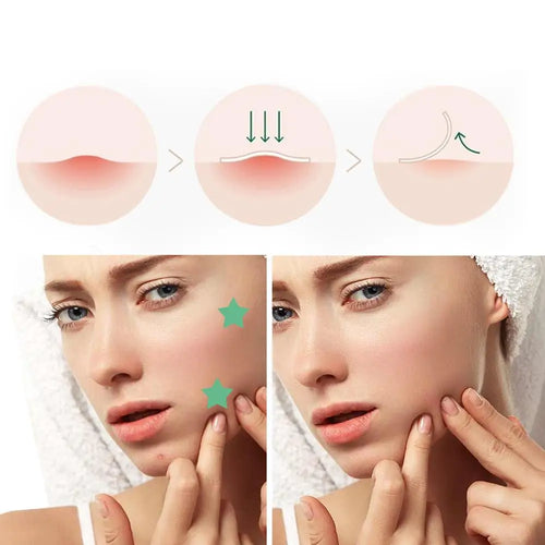 Overnight Acne Healing Patch